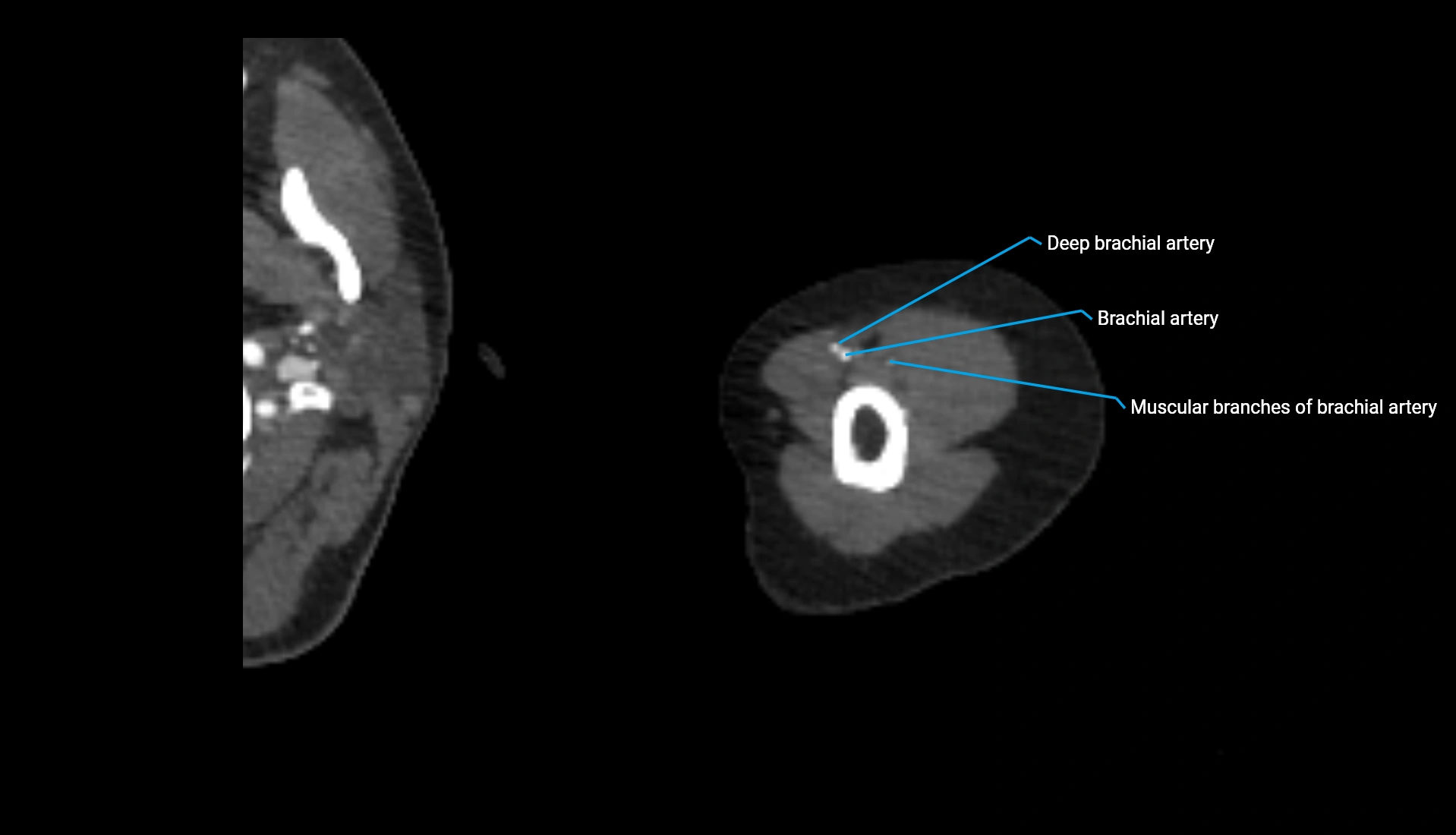 CTA upper limb axial cross sectional anatomy labelled image 279 (2).webp
